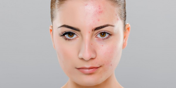 Acné: Fisiopatología, Hábitos Saludables y Effaclar AI como Solución desde la Farmacia