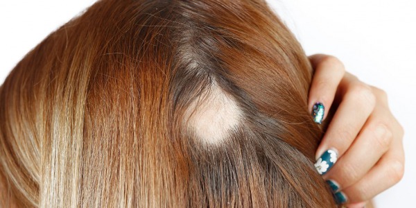 Alopecia areata: causas, síntomas y consejos 