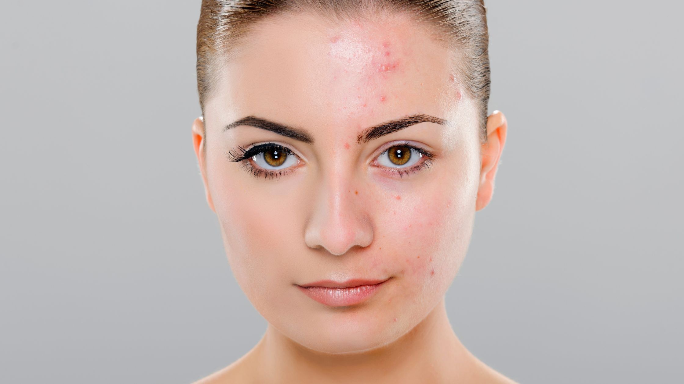 Acné: Fisiopatología, Hábitos Saludables y Effaclar AI como Solución desde la Farmacia