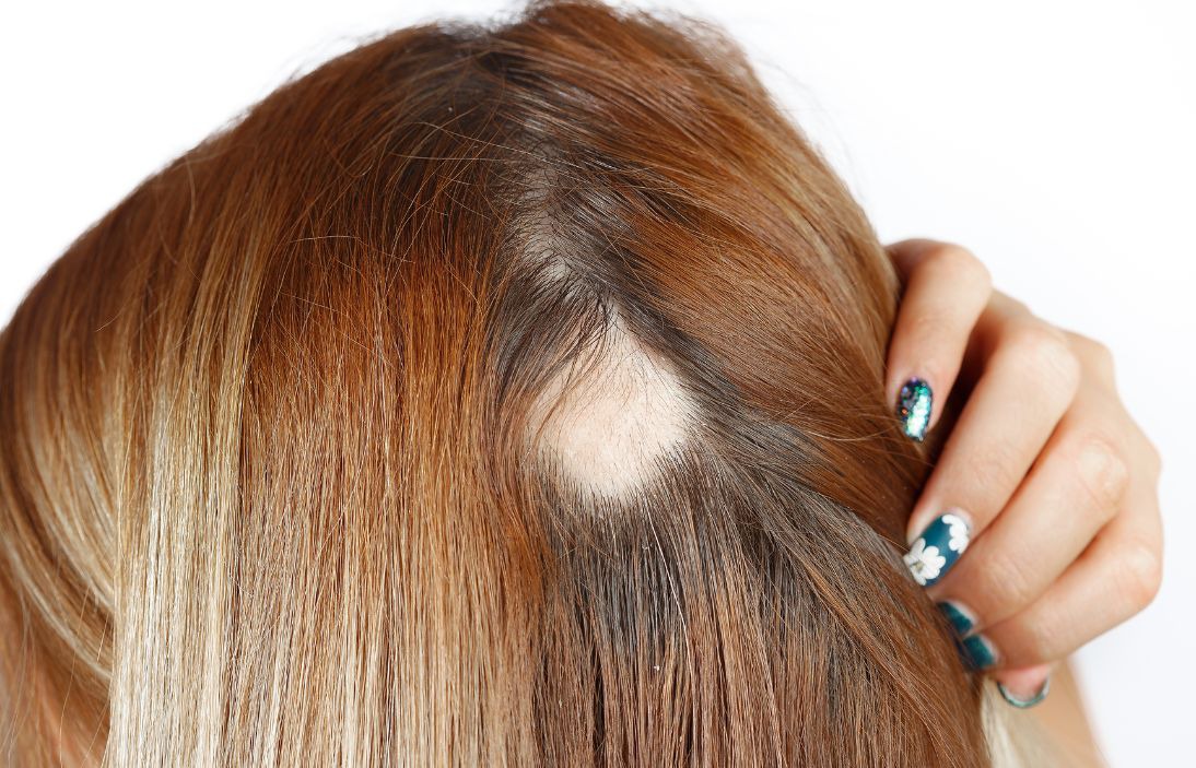 Alopecia areata: causas, síntomas y consejos 